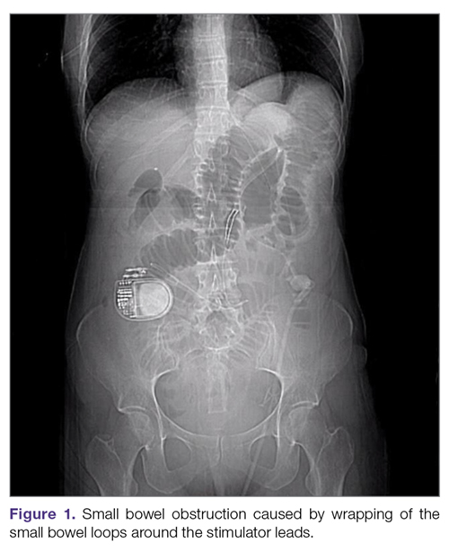 Small bowel obstruction caused by wrapping of the small bowel loops around the stimulator leads.