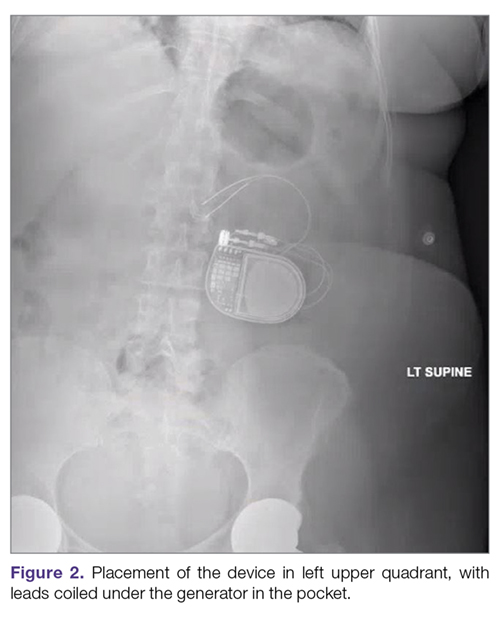 Placement of the device in left upper quadrant, with leads coiled under the generator in the pocket.