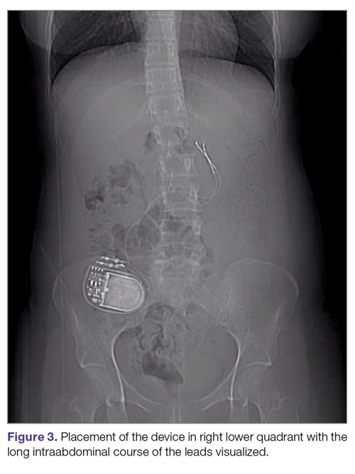 Placement of the device in right lower quadrant with the long intraabdominal course of the leads visualized.