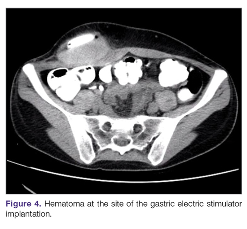 Hematoma at the site of the gastric electric stimulator implantation.