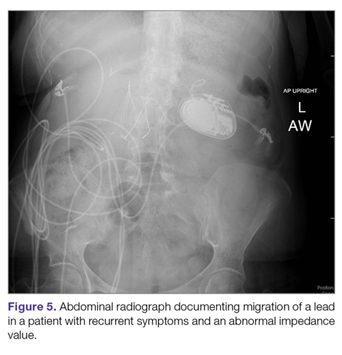 Abdominal radiograph documenting migration of a lead in a patient with recurrent symptoms and an abnormal impedance value.