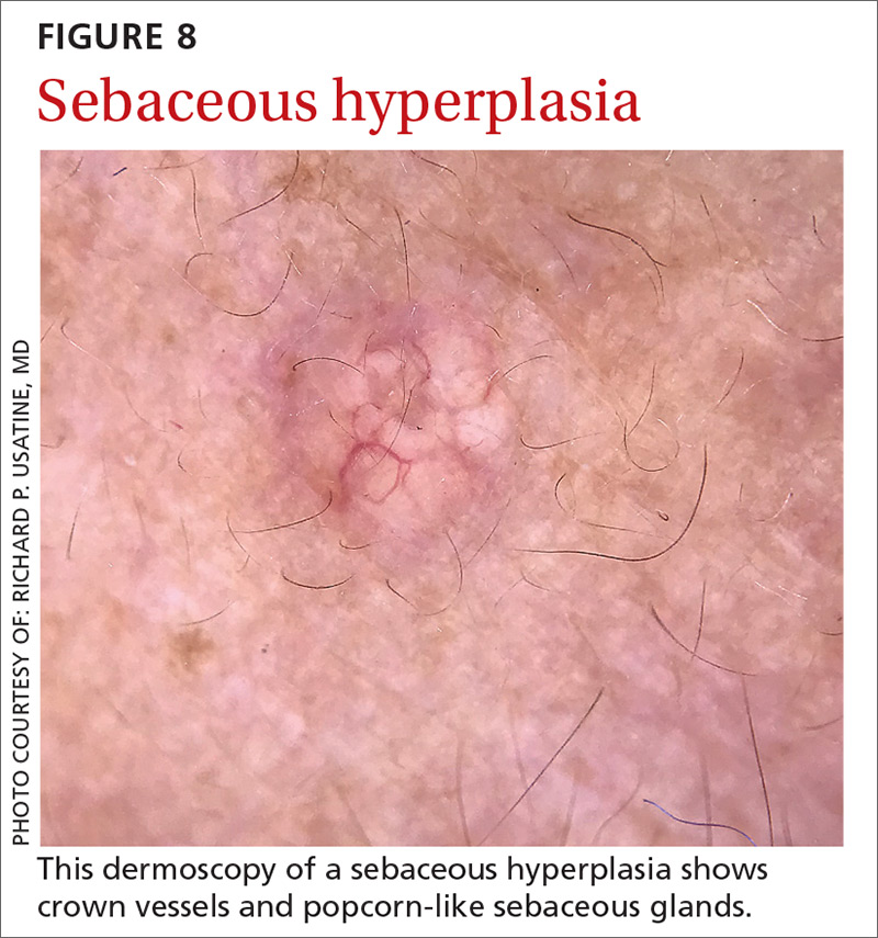 Sebaceous hyperplasia