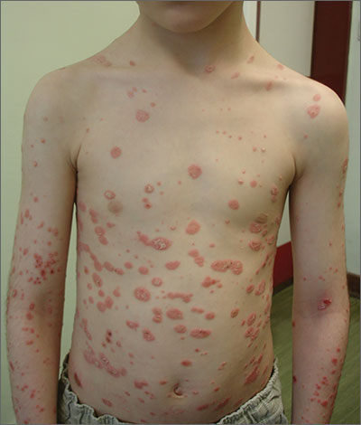 Pruritic rash on trunk  MDedge Family Medicine