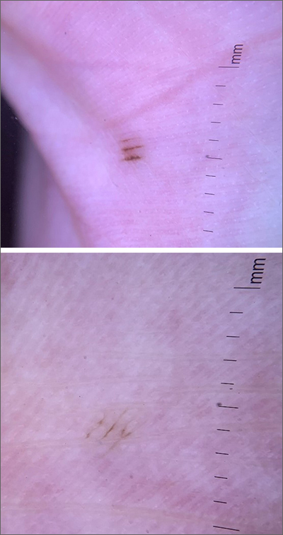 Pigmented palmar lesions