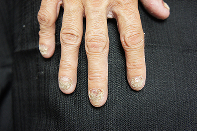 Nail dystrophy 