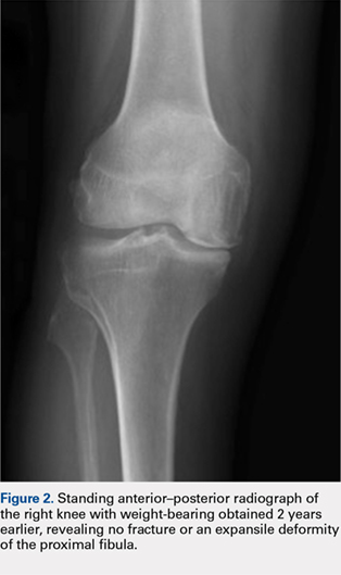 Standing anterior-posterior radiograph of the right knee