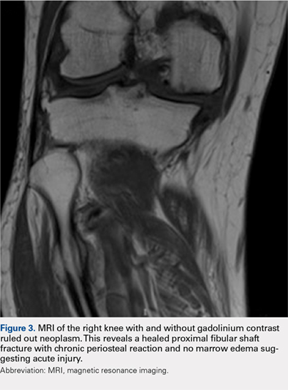 MRI of the right knee