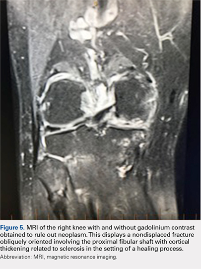 MRI of the right knee