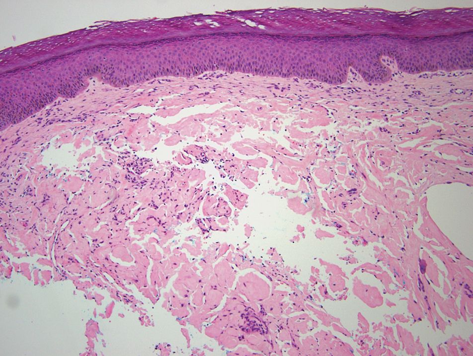  eosinophilic amorphous deposits with fissuring in the dermis 