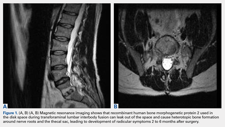 Magnetic resonance imaging shows that recombinant human bone morphogenetic protein 2 used in the disk space during transforaminal lumbar interbody fusion can leak out of the space and cause heterotopic bone formation around nerve roots and the thecal sac