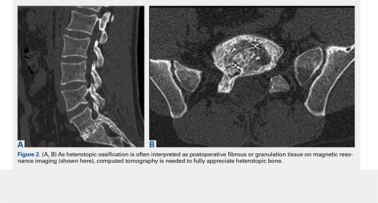 As heterotopic ossification is often interpreted as postoperative fibrous or granulation tissue on magnetic resonance imaging, computed tomography is needed to fully appreciate heterotopic bone.