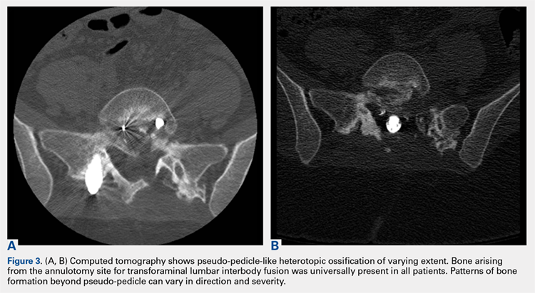 Computed tomography shows pseudo-pedicle-like heterotopic ossification of varying extent. Bone arising from the annulotomy site for transforaminal lumbar interbody fusion was universally present in all pateints.