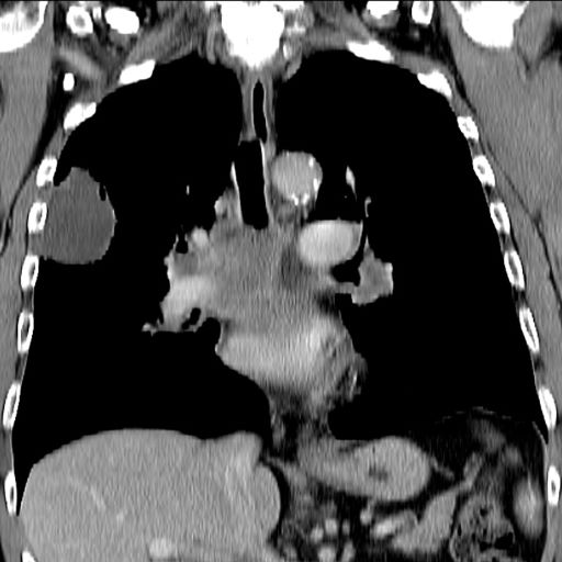 increasing-fatigue-and-dry-cough-sclc-challenge-center