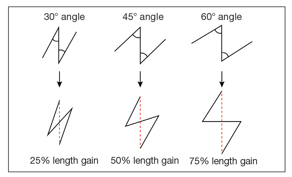 Variations of Z-plasty using different angles and their subsequent change in scar length and orientation of the central limb