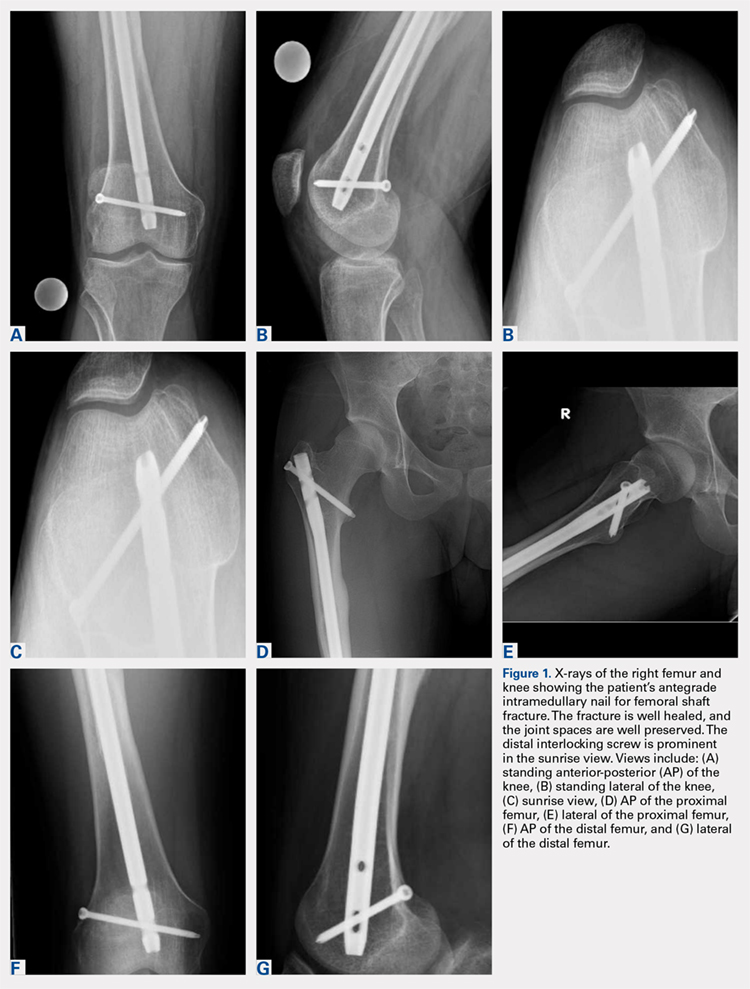 Retrograde Femoral Nail (Implant 420) - orthopaediclist.com