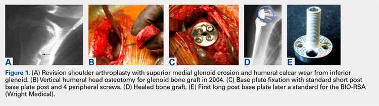 Revision shoulder arthroplasty with superior medial glenoid erosion and humeral calcar wear from inferior glenoid