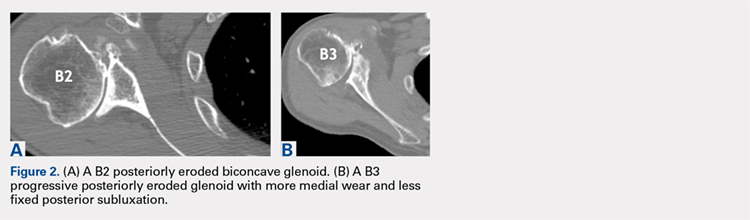 (A) A B2 posteriorly eroded biconcave glenoid. (B) A B3 progressive posteriorly eroded glenoid with more medial wear and less fixed posterior subluxation.