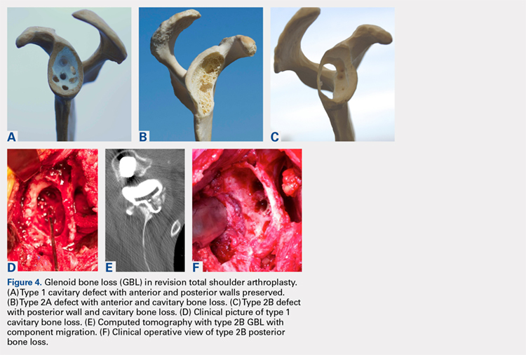 Glenoid bone loss (GBL) in revision total shoulder arthroplasty