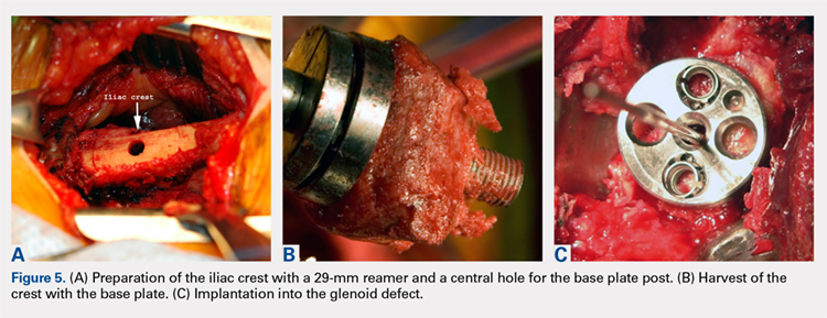 Preparation of the iliac crest with a 29-mm reamer and a central hole for the base plate post