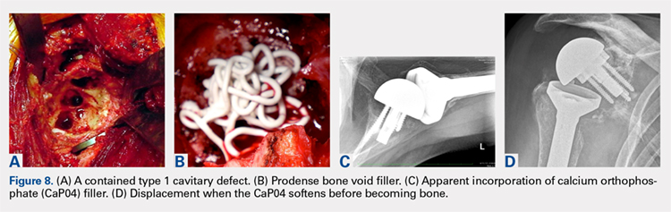 A contained type 1 cavitary defect