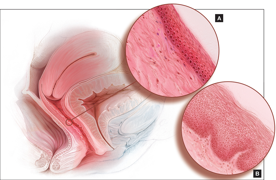 Sexual Dysfunction in Women