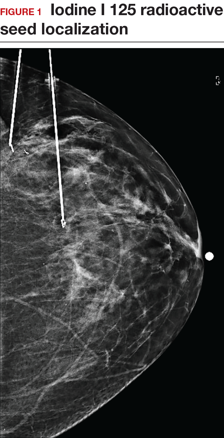 Localisation accuracy with iodine‐125 seed versus wire guidance for breast  cancer surgery - Ratnagobal - 2023 - Journal of Medical Radiation Sciences  - Wiley Online Library