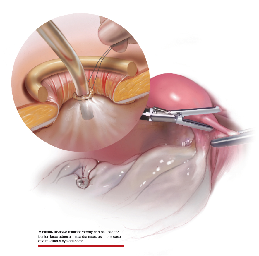 Ooforoplastia e salpingectomia laparoscópica / Oophoroplasty and  laparoscopic salpingectomy (left). 