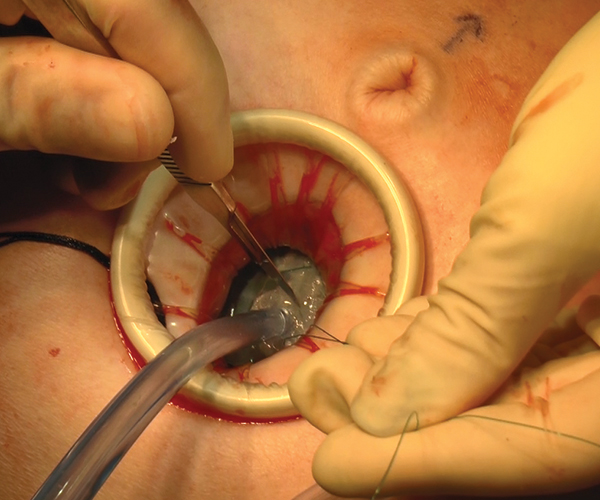 Ooforoplastia e salpingectomia laparoscópica / Oophoroplasty and  laparoscopic salpingectomy (left). 