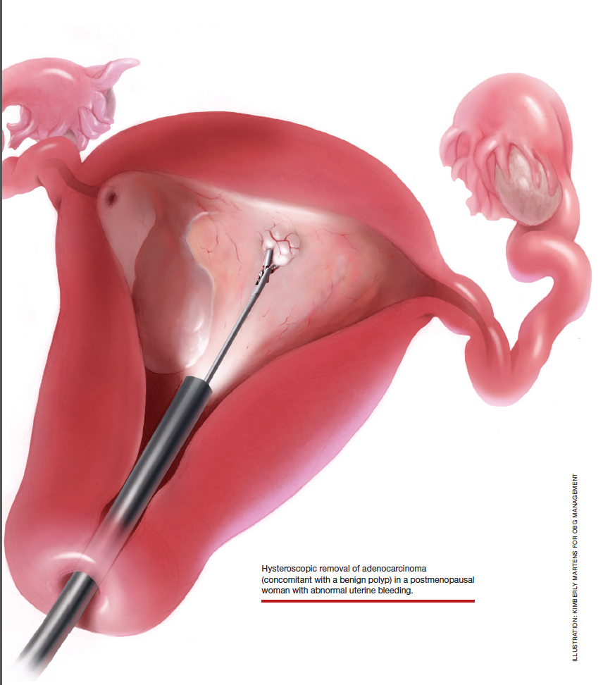 Evaluation of abnormal uterine bleeding in postmenopausal women.