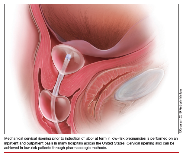 server kleuring accumuleren The case for outpatient cervical ripening for IOL at term for low-risk  pregnancies | MDedge ObGyn