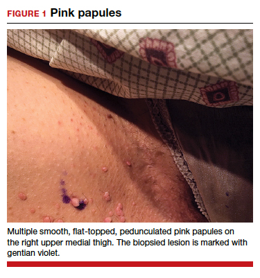 Can you identify these numerous papules in the groin area?