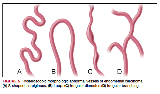 A genitális szemölcsök eltávolítása kriodestrukcióval Nemi szervi szemölcsök