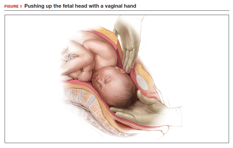Figure 3 from Emergent Cesarean Section in a Bandl's Ring Patient: An  Obstetrics and Gynecology Simulation Scenario | Semantic Scholar