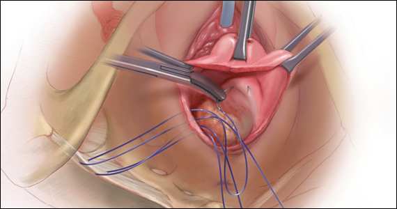 Options and outcomes for uterine preservation at the time of prolapse  surgery