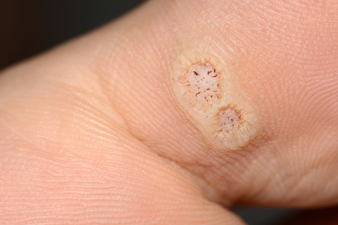 Topical or intralesional cidofovir an option for recalcitrant warts