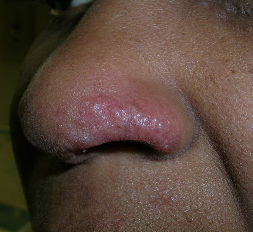 Vær sød at lade være bilag legeplads Swelling on nose | MDedge Family Medicine