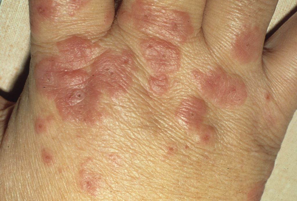 herpes on knuckles
