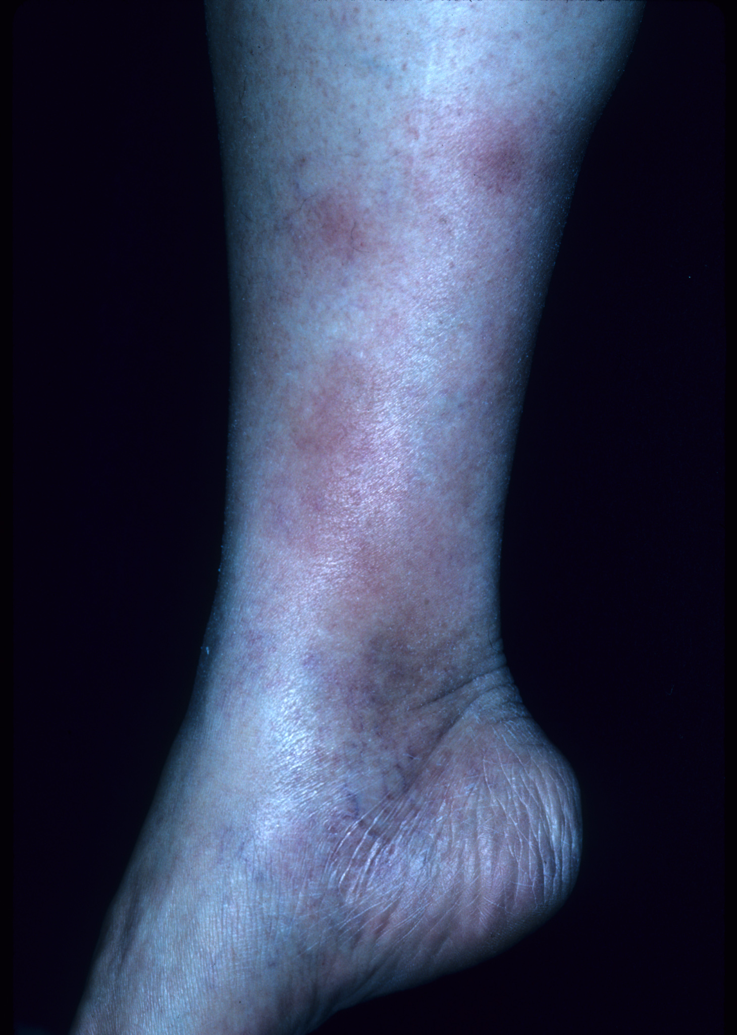 erythema nodosum legs