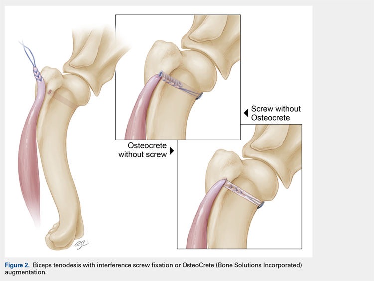 Biceps tenodesis with interference screw fixation or OsteoCrete (Bone Solutions Incorporated) augmentation