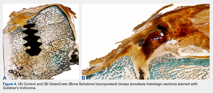 (A) Control and (B) OsteoCrete (Bone Solutions Incorporated) biceps tenodesis histologic sections stained with Goldner's trichrome.