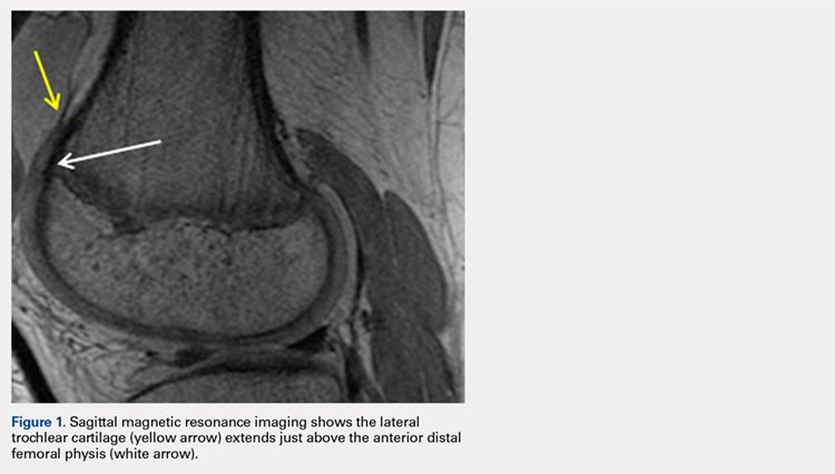 Sagittal magnetic resonance imaging shows the lateral trochlear cartilage extends just above the anterior distal femoral physis