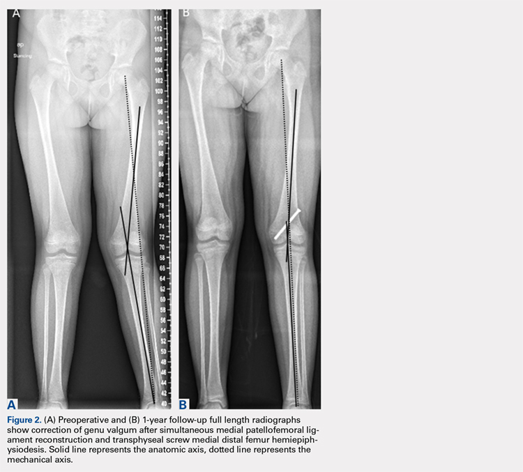 (A) Preoperative and (B) 1-year follow-up full length radiographs show correction of genu valgum after simultaneous medial patellofemoral ligament reconstruction and transphyseal screw medial distal femur hemiepiphysiodesis