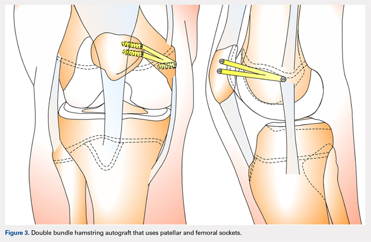 Double bundle hamstring autograft that uses patellar and femoral sockets