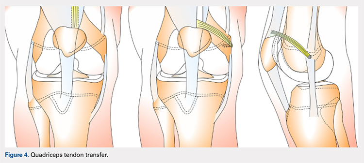 Quadriceps tendon transfer