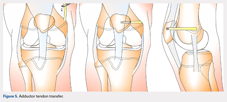 Adductor tendon transfer