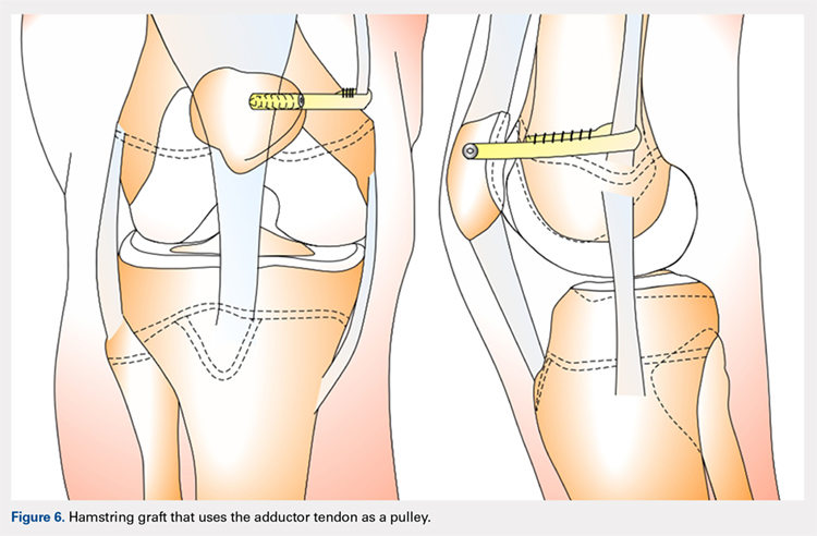 Hamstring graft that uses the adductor tendon as a pulley