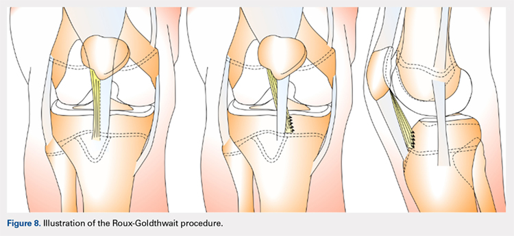 Illustration of the Roux-Goldthwait procedure