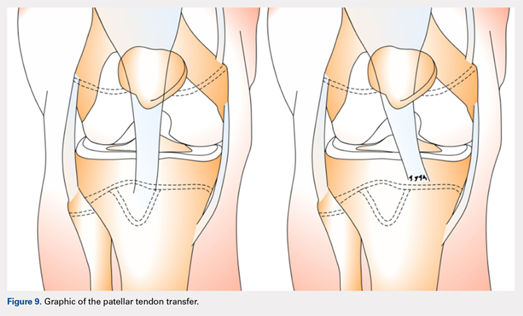 Graphic of the patellar tendon transfer