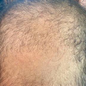 Hypotrichosis and hair loss on the occipital scalp