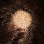 Focal hair loss
